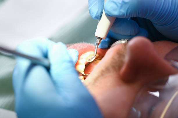 Best Emergency Dentist for Knocked-Out Tooth in Great Falls, MT